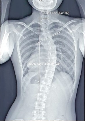 Hình chụp X-quang tình trạng cong vẹo cột sống của bệnh nhân nữ V.L.A. (19 tuổi). Ảnh BVCC.