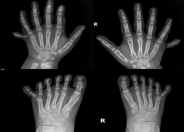 Hình ảnh chụp X-quang bàn tay, bàn chân của bé T.L.