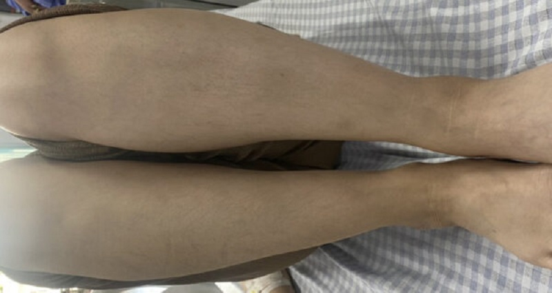 Hình ảnh chân của người bệnh thời điểm nhập viện. (Ảnh: BVĐK tỉnh Phú Thọ)