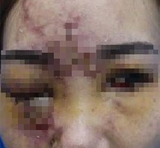Một trường hợp biến chứng nặng sau khi tiêm filler vùng mặt. (Ảnh minh họa - B.V.D.L.)