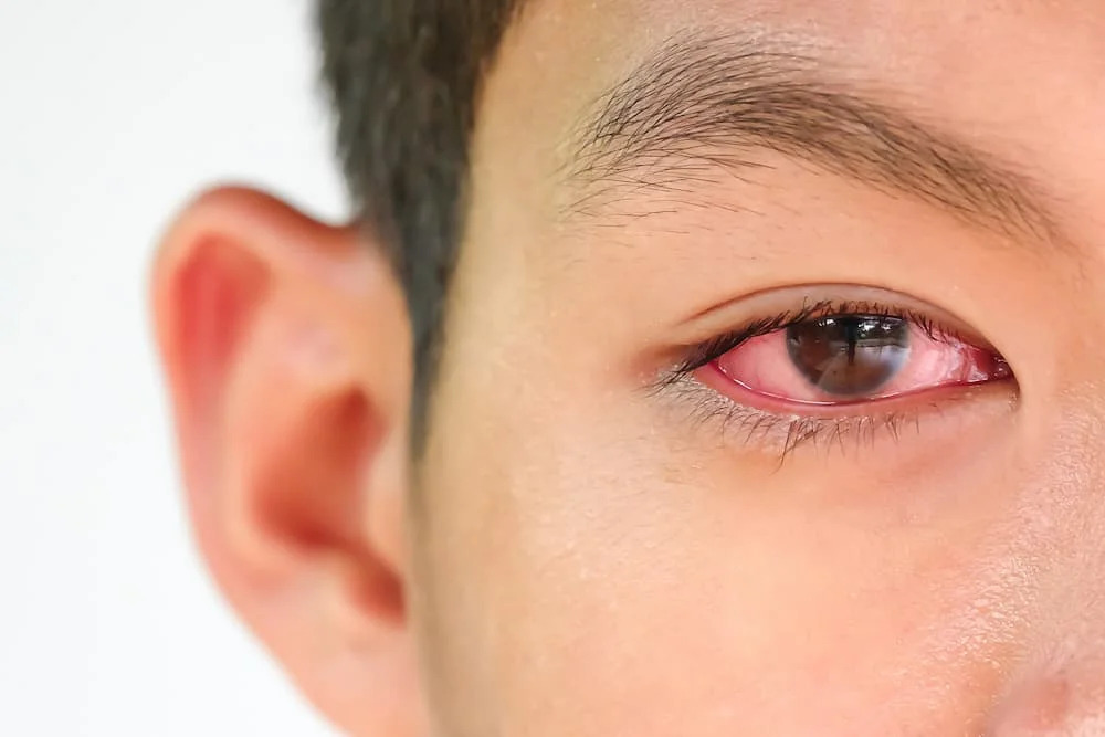 Đau mắt đỏ là căn bệnh có thể gặp ở mọi lứa tuổi. (Ảnh: BVMSG).