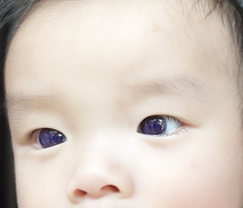 Đôi mắt cậu bé bỗng chuyển sang màu xanh sáng chỉ một ngày sau khi điều trị COVID-19 bằng favipiravir. (Ảnh: New York Post)