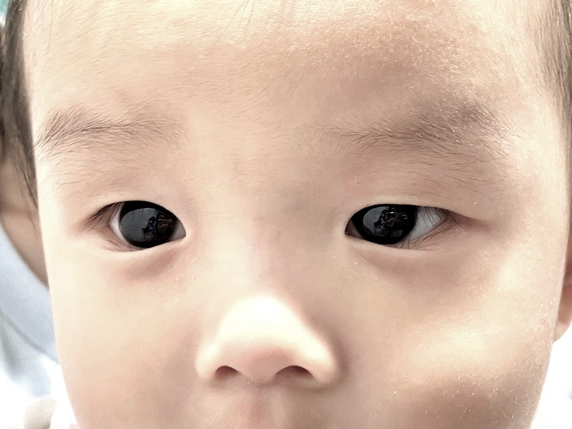 Bé trai 6 tháng tuổi vốn có đôi mắt màu nâu sẫm. (Ảnh: New York Post)