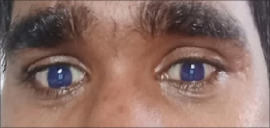 Nam thanh niên 20 tuổi ở Ấn Độ cũng từng bị đổi màu mắt sau khi sử dụng favipiravir. (Ảnh: New York Post)