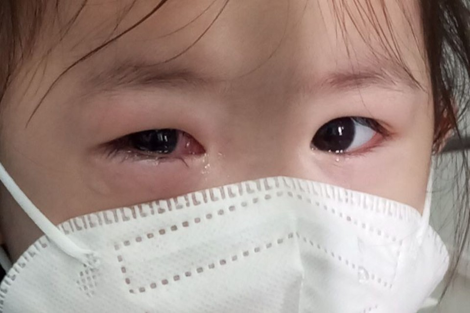Bệnh nhi đau mắt đỏ đến khám tại Bệnh viện Mắt TP HCM. (Ảnh: BVCC)