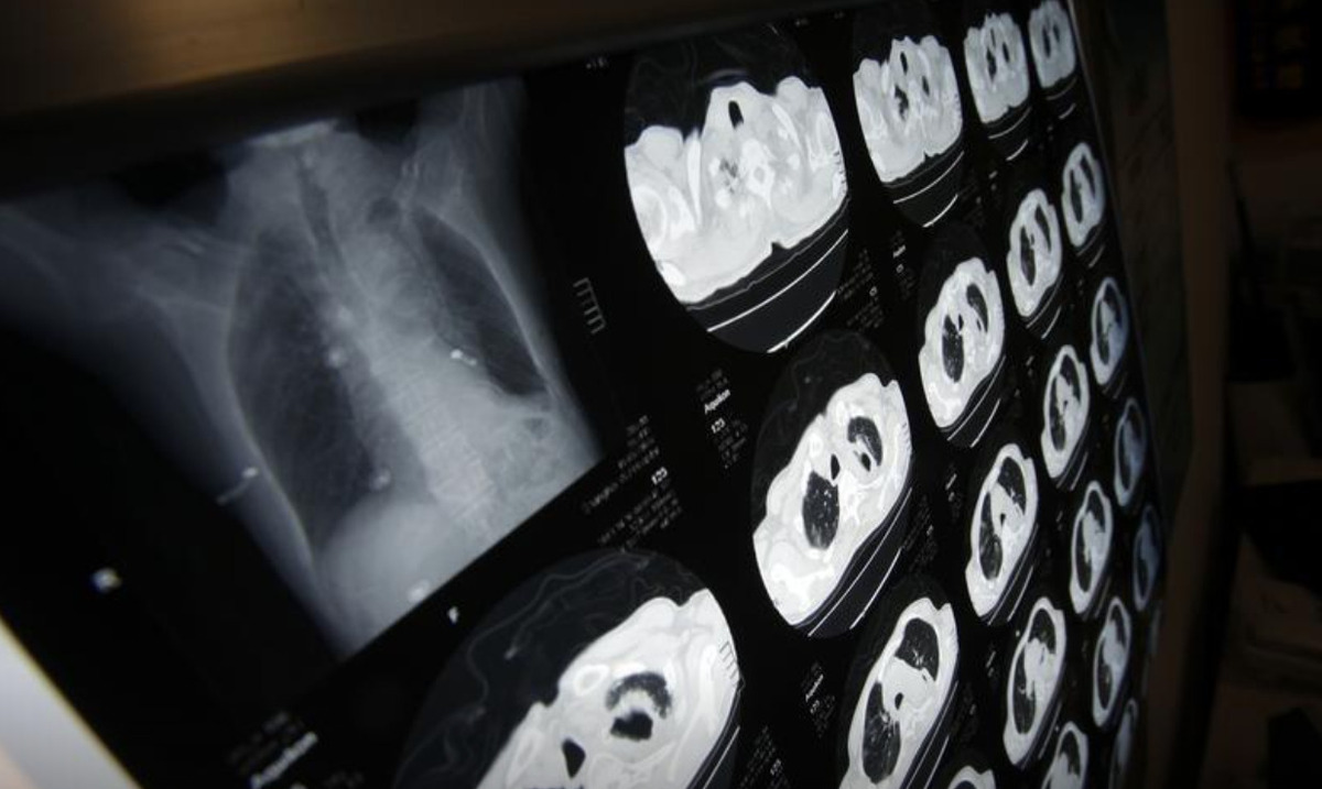 Ảnh X-quang của một bệnh nhân có khối u ở phổi do hút thuốc. (Ảnh: Reuters)