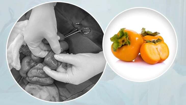 Điều trị cho bệnh nhi tắc ruột do ăn hồng giòn tại Nghệ An. (Ảnh: BVCC).