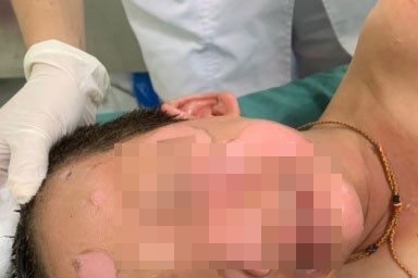 Một bệnh nhi 4 tuổi tại Quảng Nam phải nhập viện điều trị trong tình trạng bỏng nặng vùng mặt, đầu và cổ. (Ảnh: B.V.C.C.)  