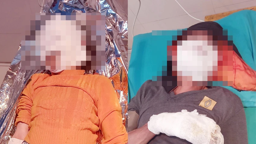 Hai vợ chồng ở Tuyên Quang bị bỏng nặng do điện thoại phát nổ. (Ảnh: BVCC)  