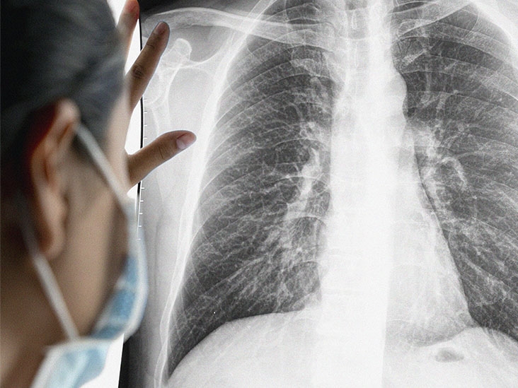 Bệnh nhân nam 66 tuổi được chẩn đoán mắc ung thư phổi và đại trực tràng, đã di căn. (Ảnh minh họa)