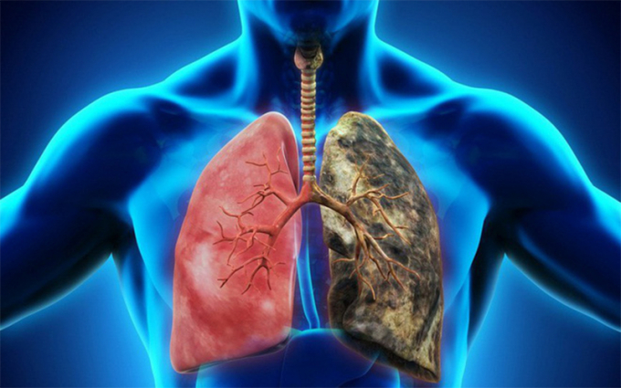 Ung thư phổi là căn bệnh đứng đầu bảng trong danh sách 10 loại ung thư phổ biến ở cả 2 giới