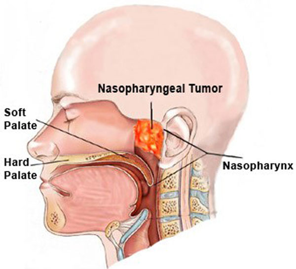 Ung thư vòm họng (tên tiếng Anh: Nasopharyngeal Carcinoma - NPC) là tình trạng lớp niêm mạc vùng vòm họng có xuất hiện sang thương ác tính