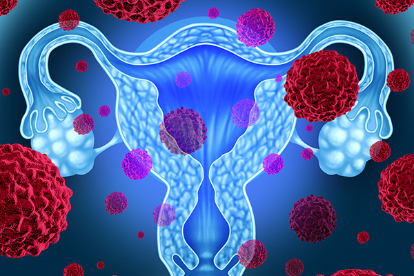 Ung thư biểu mô buồng trứng tên tiếng Anh là epithelial ovarian cancer. Đây là căn bệnh ung thư phổ biến ở nữ giới, sau ung thư vú và ung thư cổ tử cung