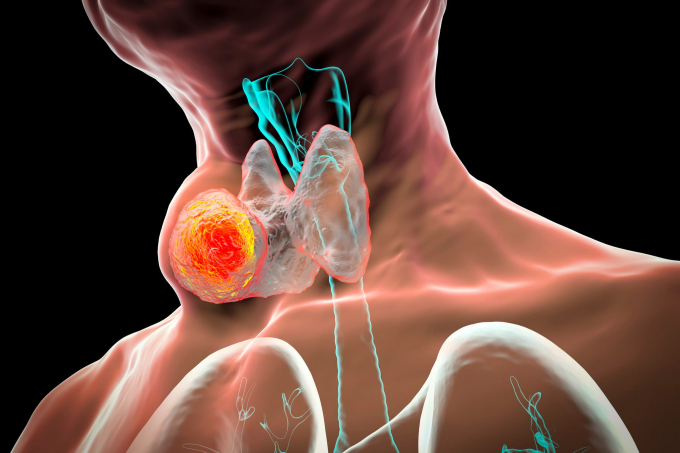 Ung thư tuyến giáp có tên tiếng Anh là Thyroid cancer. Đây là bệnh thường gặp ở nữ nhiều hơn nam giới. Dấu hiệu ung thư tuyến giáp giai đoạn đầu thường không rõ ràng và rất khó phát hiện