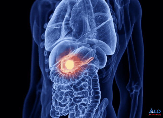 Ung thư tuyến tụy có tỉ lệ tử vong cao nhất trong các loại ung thư
