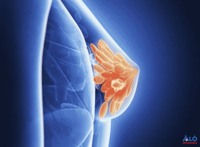 Theo các chuyên gia, nếu được phát hiện ở giai đoạn sớm (giai đoạn 0, I), tỷ lệ điều trị khỏi ung thư vú lên tới 95%