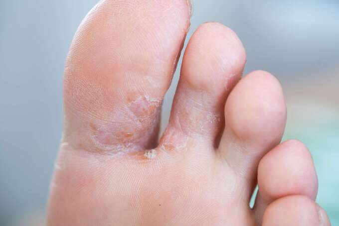 Tình trạng bong tróc xảy ra giữa các ngón chân sau thời gian dài bị nhiễm nấm. Ảnh Internet