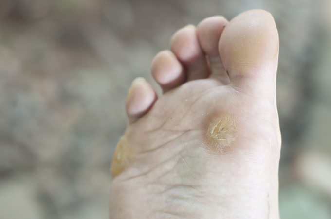 Bàn chân bị ảnh hưởng bởi virus u nhú HPV qua những vết xước, ngứa trên da. Ảnh Triad Foot