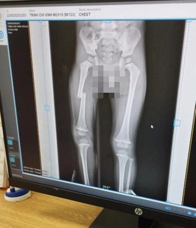 Ảnh phim chụp X- quang cho thấy xương đùi bé trai đã bị gãy (ảnh người nhà cung cấp)