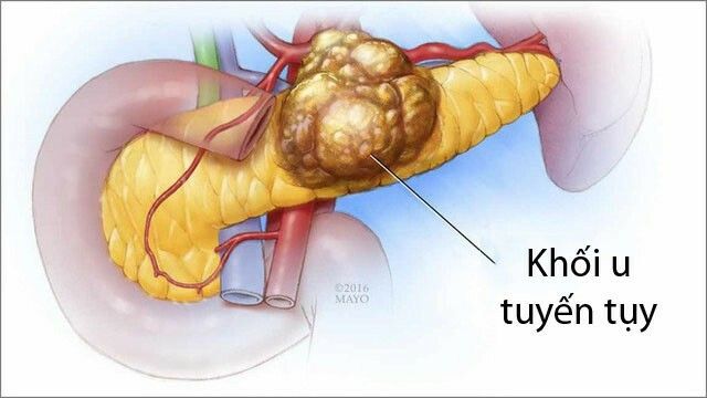 Pancreatic2