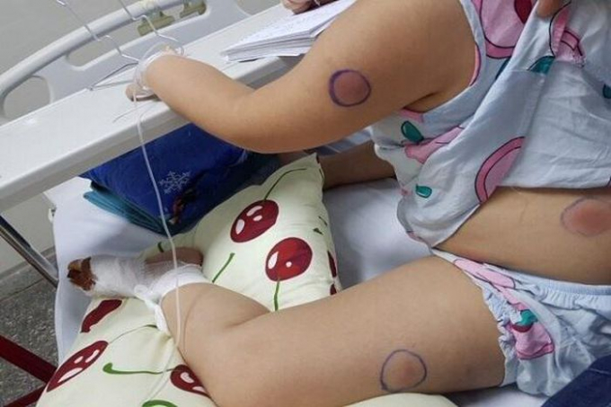 Bé P đã qua giai đoạn nguy hiểm do vi khuẩn ăn thịt người gây ra. Ảnh Bệnh viện cung cấp