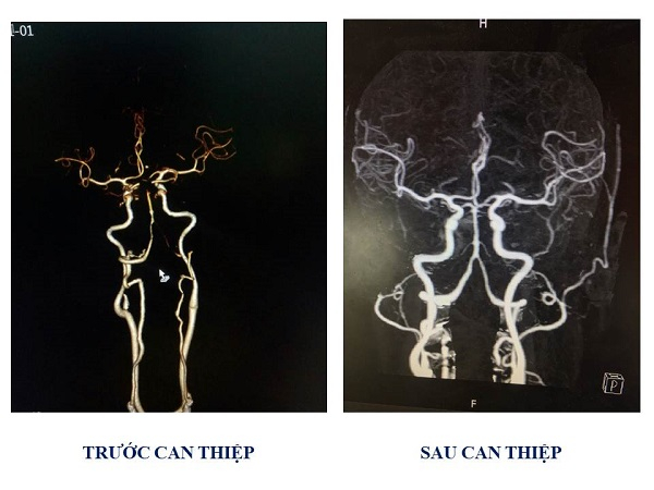 MRI