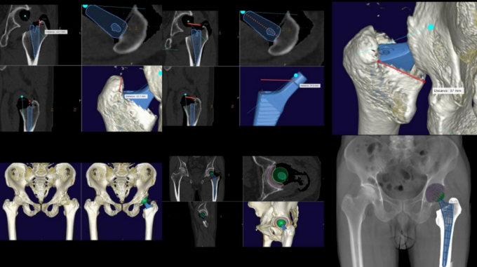 Hình ảnh kế hoạch phẫu thuật khớp háng được mô phỏng trên máy tính trước mổ