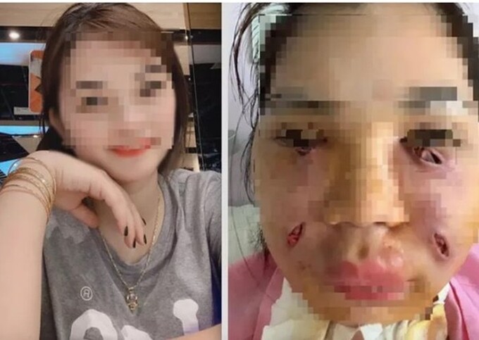 Hình ảnh cô Nguyễn Thị H. trước và sau khi bị nhiễm trùng khi thực hiện 