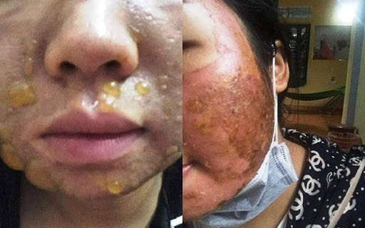 Trường hợp da bị bỏng nặng do peel sai cách hoặc sử dụng sản phẩm kém chất lượng. (Ảnh: internet)