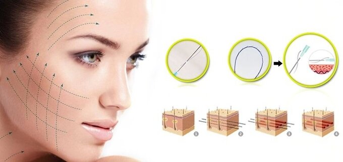 Căng chỉ da mặt là một quy trình không phẫu thuật, sử dụng các sợi chỉ đặt ở bên dưới bề mặt da để căng mô.