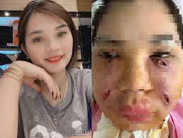 Một cô gái ở Hà Nội đã phải rạch mặt nặn một đống mủ ra vì cấy mỡ tự thân lên mặt làm đẹp bị nhiễm trùng nặng.