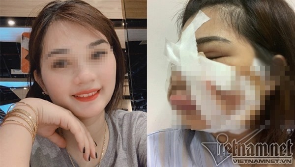 Cô gái xinh đẹp phải rạch mặt để nặn mủ sau tiêm mỡ tự thân làm đẹp. (Ảnh Vietnamnet)