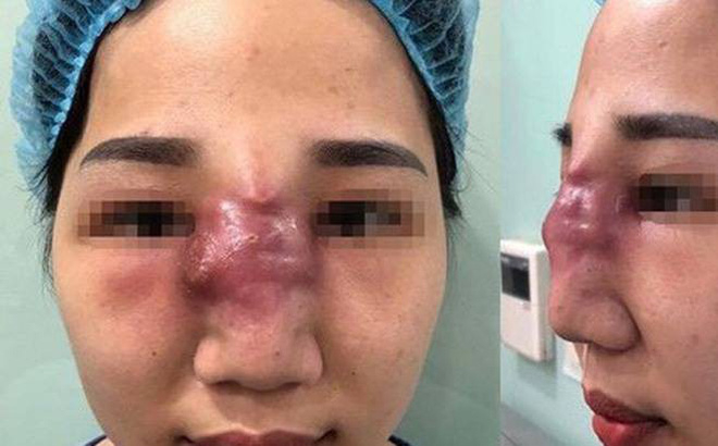 Tai biến nặng nề do tiêm filler làm đẹp.