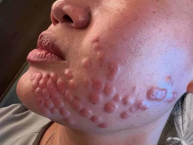 Biến chứng sau khi tiêm meso kém chất lượng.