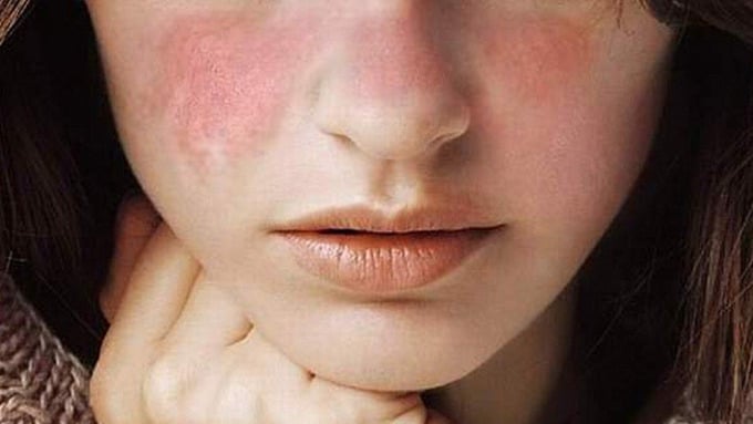 Người bệnh thường xuất hiện ban đỏ bất thường trên da.