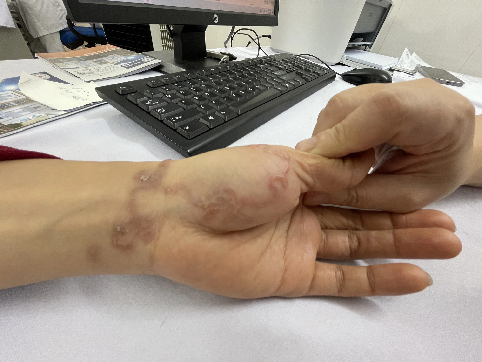 Bệnh nhân bị bệnh ấu trùng di chuyển ở da (Cutaneous larval migrans – creeping eruption) do ấu trùng giun sán có trong nước lũ xâm nhập vào da. Ảnh: Báo Sức khỏe và đời sống