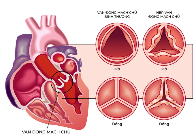 Hẹp van động mạch chủ làm cản trở quá trình lưu thông máu của tim. Ảnh: Shutterstock