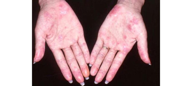 4. Chẩn đoán lupus ban đỏ