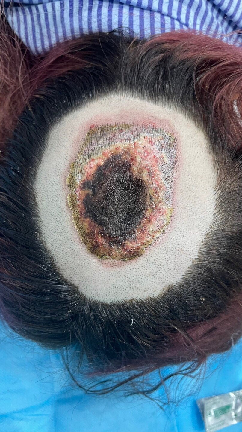 Hình ảnh tổn thương loét hoại tử rộng vùng đỉnh đầu ở bệnh nhân nữ 22 tuổi sau tẩy tóc tại tiệm làm tóc.