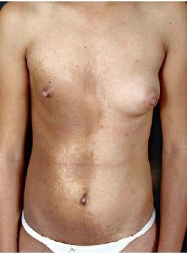Ảnh 2: Hội chứng bớt Becker có thiểu sản tuyến vú