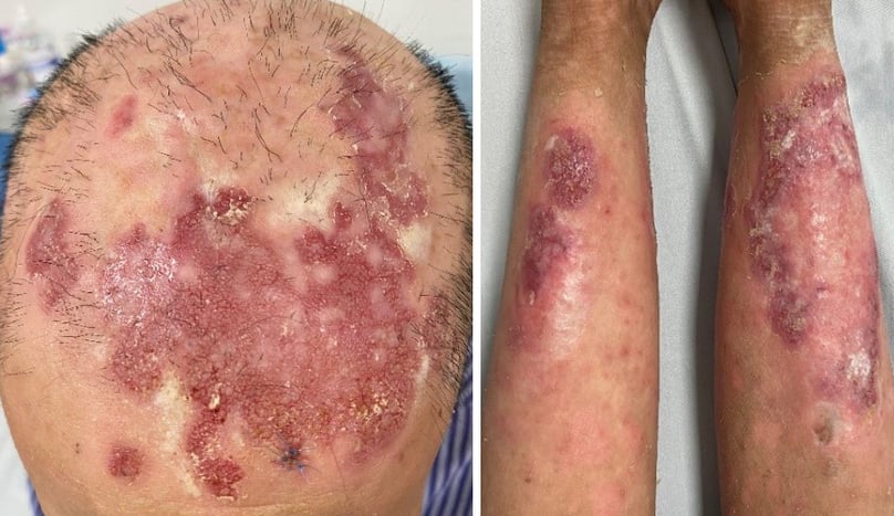 Hình 5: Tổn thương da dầu và cẳng chân sau khi điều trị 7 ngày
