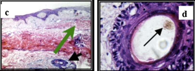 (c) Nang lông chứa vi sinh vật ở vùng giảm sắc tố và được bao quanh bởi thâm nhiễm viêm nhẹ quanh tổn thương (mũi tên đen), giảm sắc tố nằm phía trên nang lông (mũi tên xanh). (d) Nang lông chứa vi sinh vật.