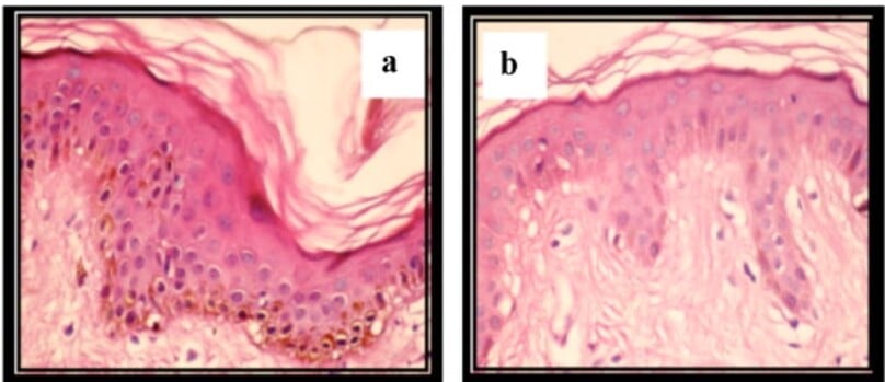 Giảm phản ứng dopa-oxidase (màu nâu) ở da bị giảm sắc tố (b) so với da bình thường (a)