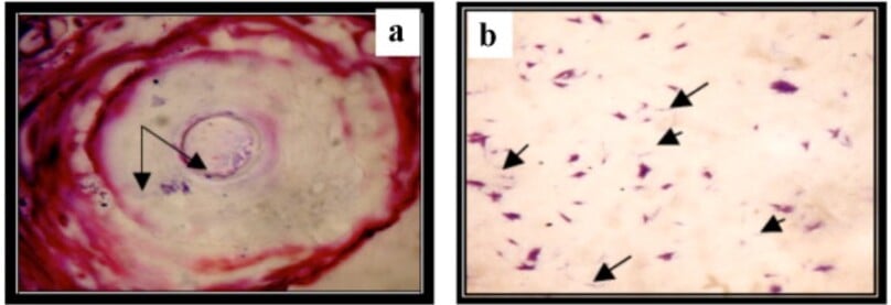 Trực khuẩn gram dương bên trong nang lông (a) và trong phết làm kính từ sinh thiết da (b)