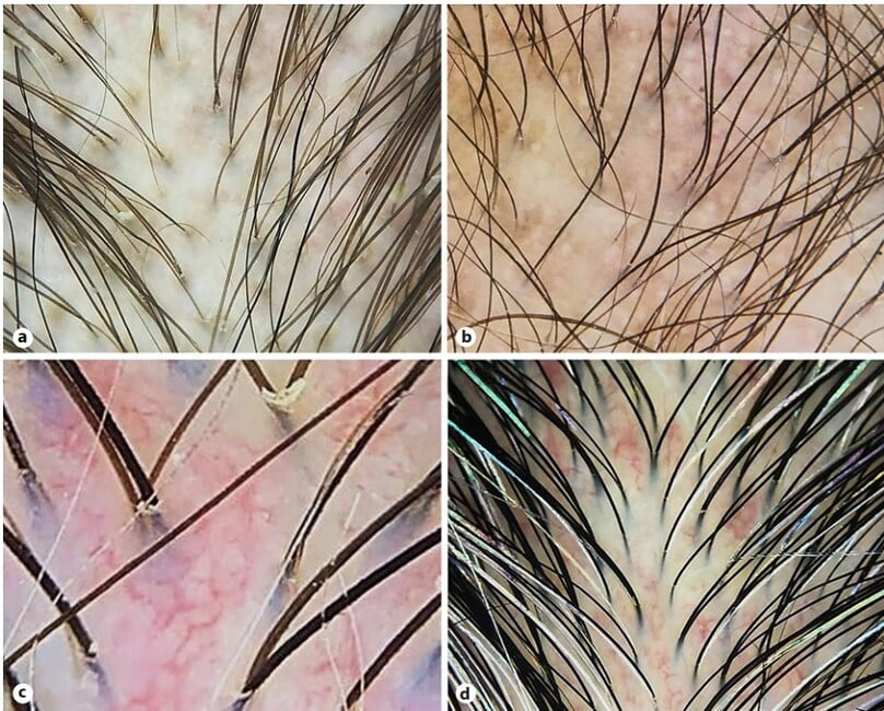 Hình 1. Trichoscopy trong lupus ban đỏ hệ thống: (a): giảm mật độ, đường kính và sắc tố tóc; (b) chấm đen, chấm trắng, sắc tố nâu rải rác, sắc tố xanh xám rải rác; (c), (d) mạch máu giãn rộng ngoằn ngoèo (Nguồn: Internet).