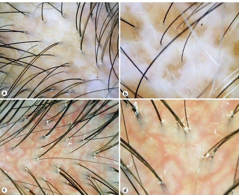 Hình 3. Trichoscopy trong xơ cứng bì: (a): giảm mật độ và đường kính sợi tóc, vùng vô mạch; (b) mảng trắng; (c) mạch máu đang hình thái, mạng lưới giãn mạch; (d) cấu trúc mạch máu được phóng đại (Nguồn: Internet).
