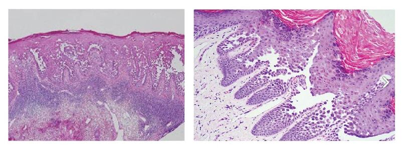 Hình 3, 4. Hình ảnh mô bệnh học trong bệnh Hailey-Hailey (Nguồn: Internet)