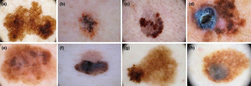 Hình ảnh Melanoma trên Dermoscopy: không đồng đều sắc tố, bờ không rõ – Nguồn: Bs. Nguyễn Hữu Quang