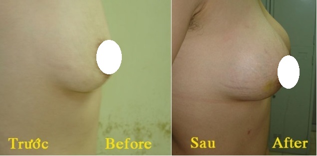 Trước và sau đặt túi gel nâng ngực tại Bệnh viện Da liễu Trung ương 15A Phương Mai – Đống Đa – HN (ảnh: BS. Phạm Cao Kiêm)