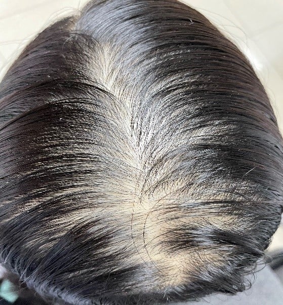 Bật mí 03 cách điều trị rụng tóc nhiều ở nữ dứt điểm chuẩn chuyên gia